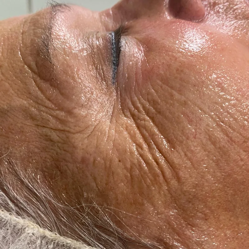 Después — Indiba Facial en Sole Centro de Imagen – antes y después