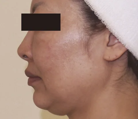 Antes — Indiba Facial – papada y óvalo facial