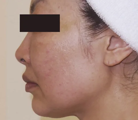 Después — Indiba Facial – papada y óvalo facial