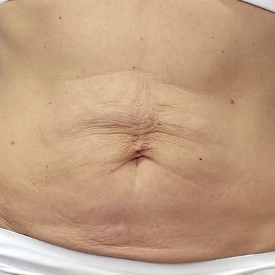 Antes — LPG Corporal – firmeza de abdomen y cintura