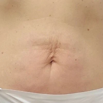Después — LPG Corporal – firmeza de abdomen y cintura