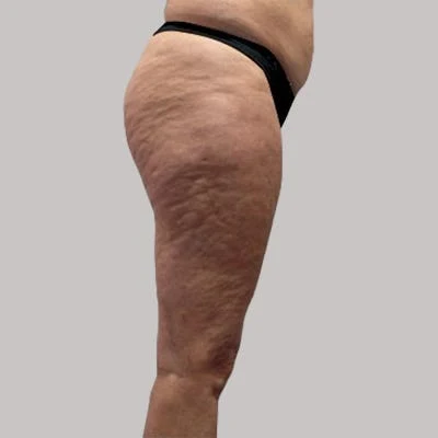 Antes — LPG Corporal – celulitis en glúteos y muslos