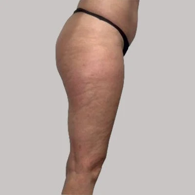 Después — LPG Corporal – celulitis en glúteos y muslos