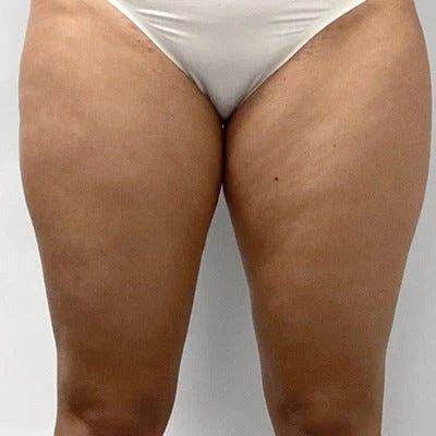 Antes — LPG Corporal – volumen en muslos