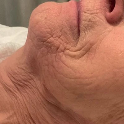 Antes — LPG Facial – antiedad