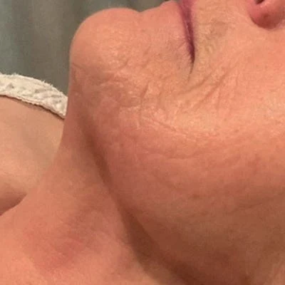 Después — LPG Facial – antiedad