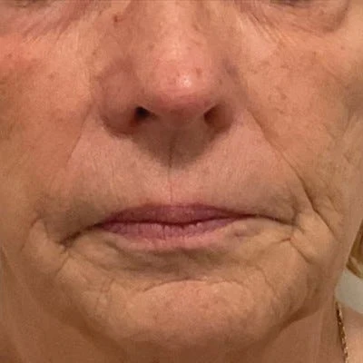 Antes — LPG Facial – firmeza
