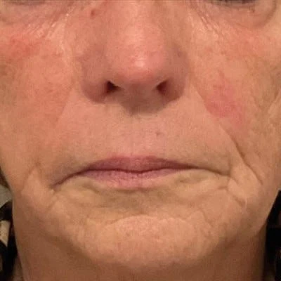 Después — LPG Facial – firmeza