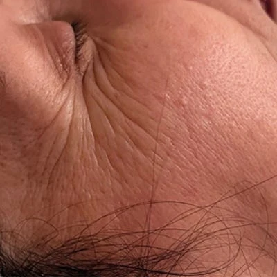 Antes — LPG Facial – antiedad y luminosidad