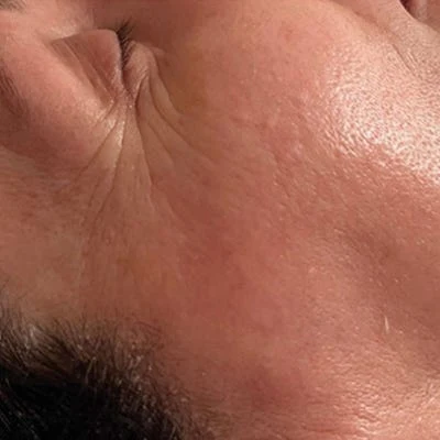 Después — LPG Facial – antiedad y luminosidad