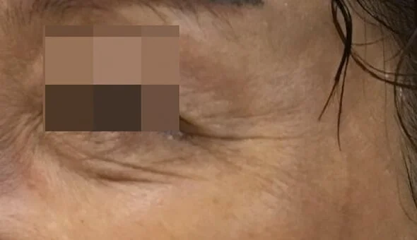 Antes — Mesoéclat – luminosidad y signos de cansancio