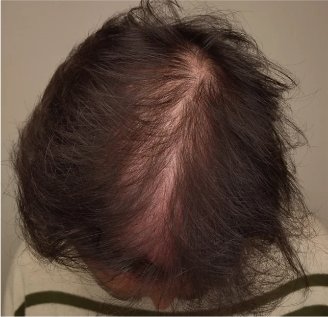 Antes — Mesoject Gun – caída del cabello