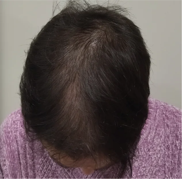 Después — Mesoject Gun – caída del cabello