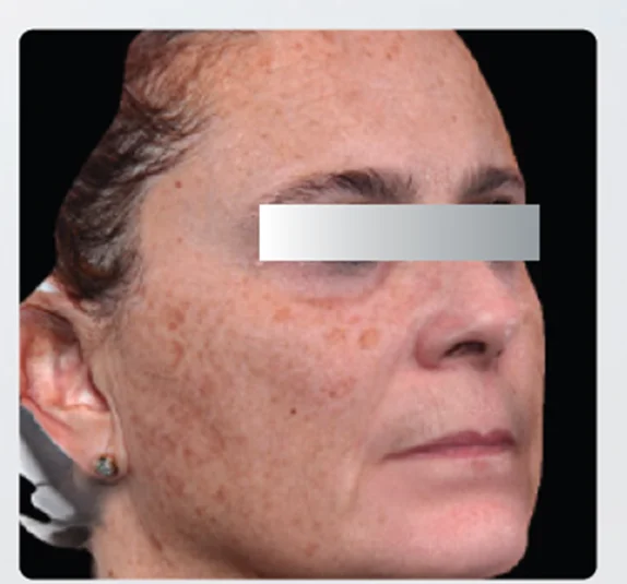 Antes — Mesoject Gun – manchas