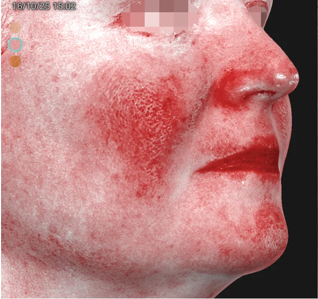 Antes — Mesoject Gun – rojeces