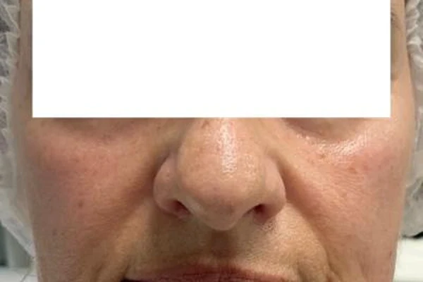 Antes — Rellenos faciales 3 - Antes