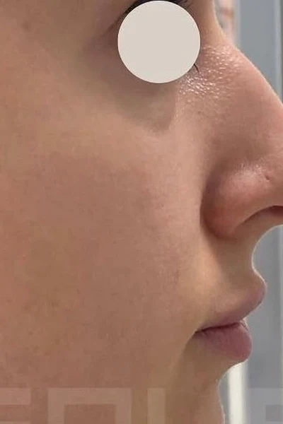 Antes — Rinomodelación y labios con ácido hialurónico – antes y después