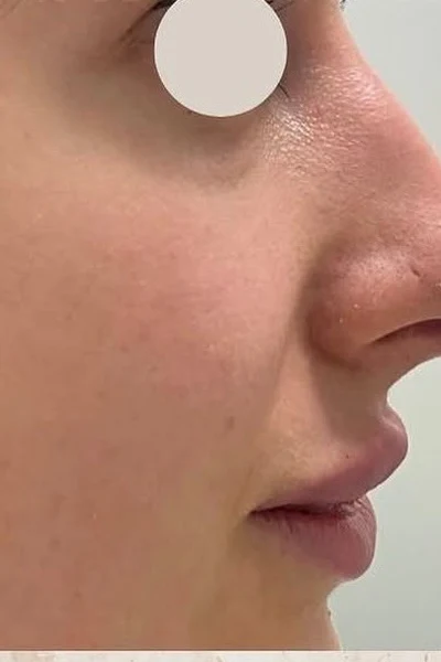 Después — Rinomodelación y labios con ácido hialurónico – antes y después