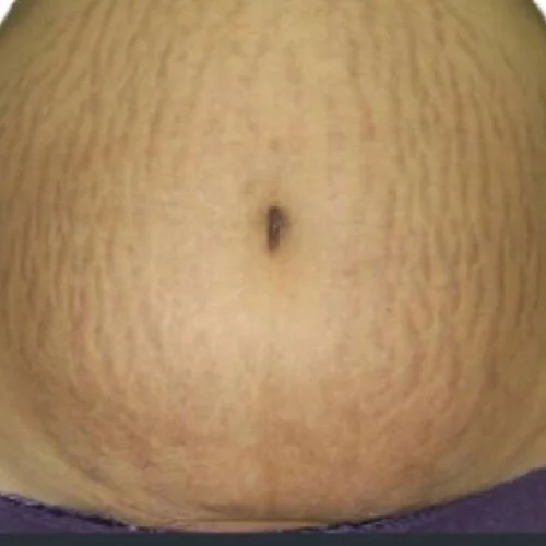 Antes — Venus Viva corporal – estrías en el abdomen