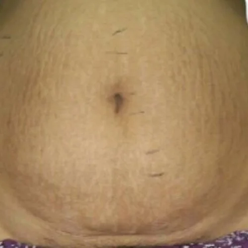 Después — Venus Viva corporal – estrías en el abdomen